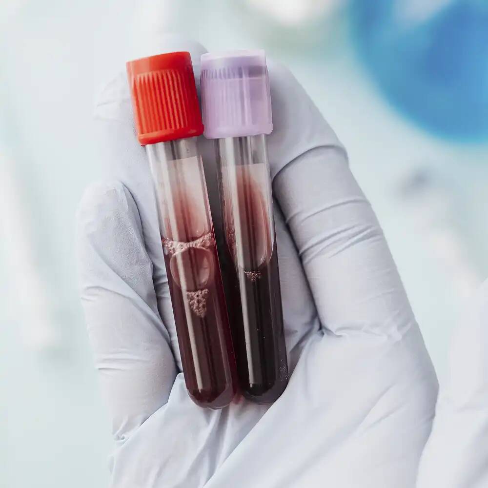 Taux de triglycérides élevé : est-ce dangereux ?